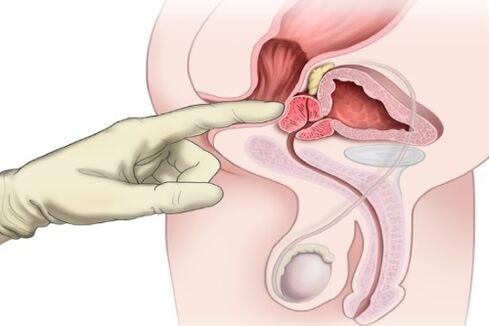 Prostate massage for prostate inflammation
