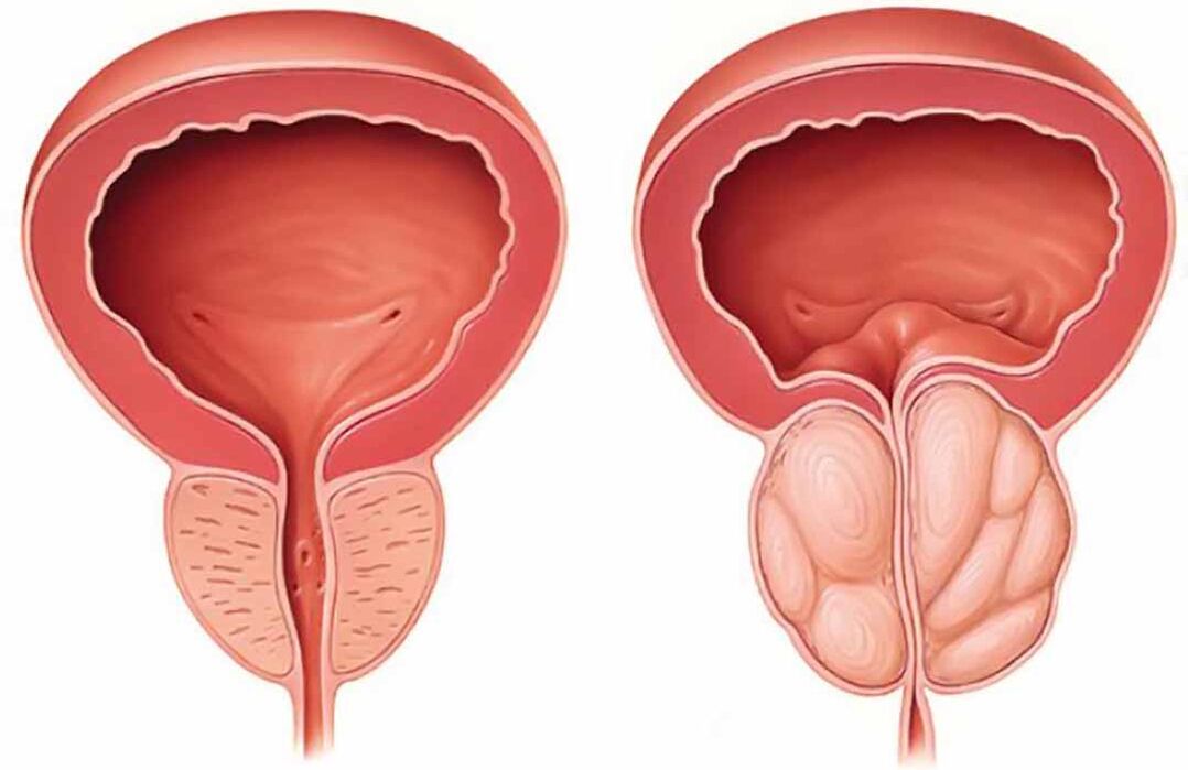 Normal prostate and inflammation of the prostate (chronic prostatitis)
