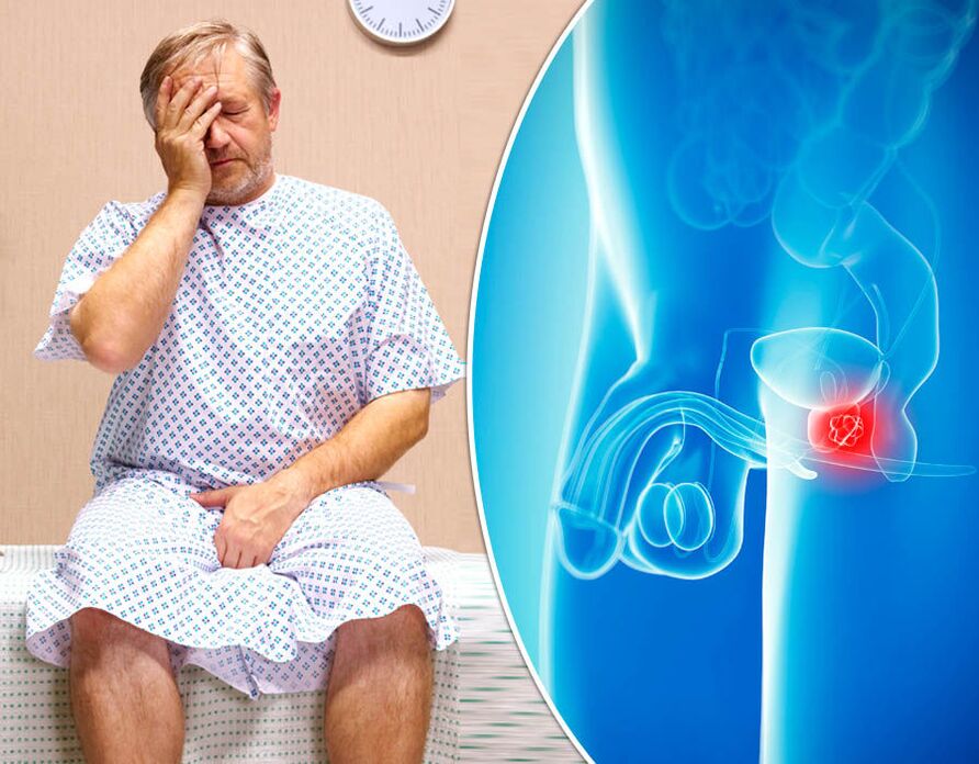 A man with prostatitis is diagnosed with the disease